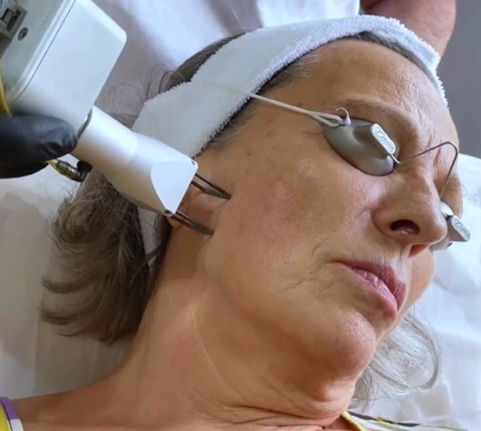 Laser fraccionado CO2 DEKA